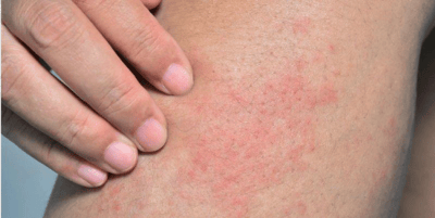 img-mild-allergy