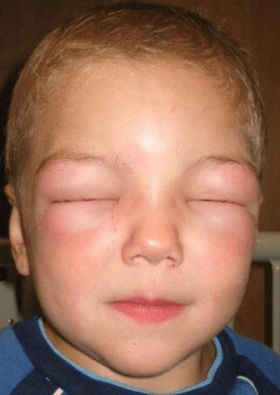 img-severe-allergy